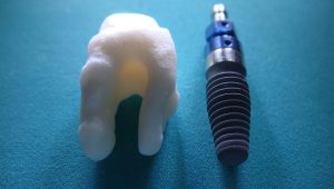 picture of a titanium implant with a ceramic dental crown